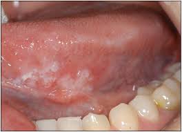 Image result for white cancer on tongue)