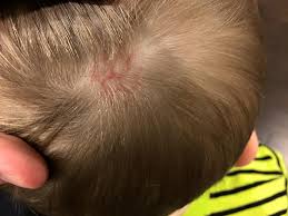 Image result for sores on the head in children