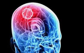 (cnn) the incidence rate of aggressive malignant brain tumors in england has more than doubled in recent decades, and a new study questions what could be driving that rise. Radically Modified Cells May Stunt Brain Tumor Growth Nsf National Science Foundation