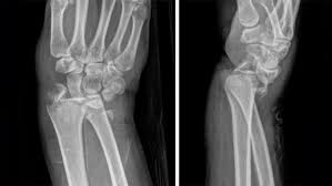 Image result for Fracture Types