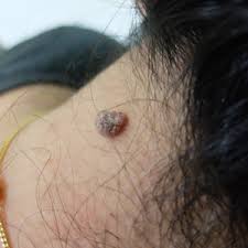 Of course, your specialist is the main person whose advice you should follow but it doesn't do anyone harm. Skin Cancer Moles Treatment In Huntington Moles Versus Skin Cancer