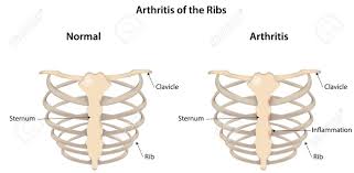 Numbered ribs, sternum, cartilage parts and clavicular articulation. Arthritis Of The Ribs Labeled Diagram Royalty Free Cliparts Vectors And Stock Illustration Image 31466046