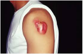Image result for Dermatofibrosarcoma Protuberans