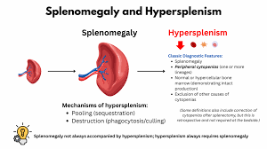 Image result for Splenomegaly