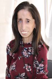 Lizzie Velasquez has had no shortage of obstacles in her life. She was born  with a rare congenital disease that prevents her from accumulating body  fat, suffers from blindness in her right