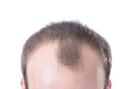 Erkek Tipi Sac Dokulmesi Androgenetik Alopesi Aga Nedir