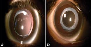 posterior capsule opacification rate after