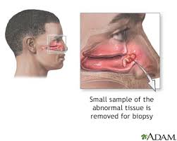 The nasal microbiome mirrors and potentially shapes olfactory function. Nasal Mucosal Biopsy Information Mount Sinai New York