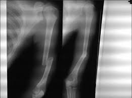 + add or change photo on imdbpro ». Percutaneous Kirschner Wire K Wire Fixation For Humerus Shaft Fractures In Children A Treatment Concept Abstract Europe Pmc