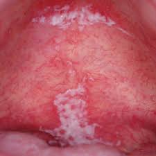 Image result for oral thrush symptoms roof of the mouth