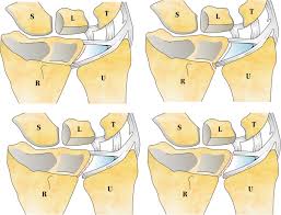 A tfcc tear is an injury to the triangular fibrocartilage complex found in the wrist. Traumatic Injury Of The Triangular Fibrocartilage Complex Tfcc A Refinement To The Palmer Classification By Using High Resolution 3 T Mri Springerlink