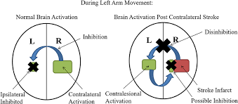 Maybe you would like to learn more about one of these? Frontiers Role Of The Contralesional Vs Ipsilesional Hemisphere In Stroke Recovery Human Neuroscience