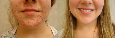 Their mechanism of action, effectiveness, and safety. Pediatric Acne Fairfield Dermatology