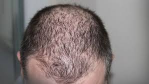 What are other types and causes of anemia? Does Iron Deficiency Lead To Hair Fall From Eggs To Spinach Foods One Must Eat For A Healthy Scalp Latestly