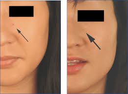 To put it in a nutshell, a cherry angioma (small or large) appears when blood vessels are proliferated at the surface level of the skin, on the face, scalp, lip or other body parts. Cherry Hemangiomas Before And After Pictures