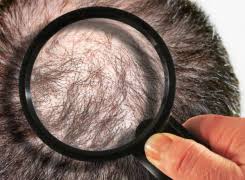 Bioidentical hormone replacement therapy includes such compounds as progesterone, estrogen, estriol, estradiol, testosterone, dhea, etc. Bioidentical Hormone Replacement Therapy For Hair Loss Call Dr Slater