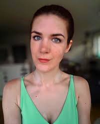 Vitiligo can affect any part of the body, including the inside of the mouth and the hair. Vitiligo Blog Selina Reinhart