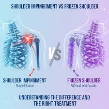 Image result for Frozen Shoulder