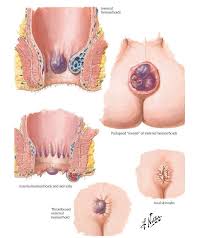 We did not find results for: What Do Hemorrhoids Look Like Hemorrhoid Pictures Photos And More