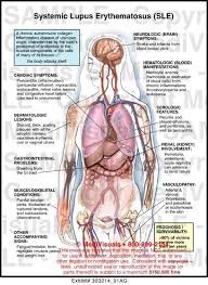 Systemic Lupus Erythematosus Sle Commonly Known As Lupus This Is What I Have Lupus Lupus Awareness Lupus Facts