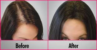 Read my other comments where i explain to take a before and after image to see if it is actually working. Beard And Company S Extra Strength Hair Growth Serum Is 100 Organic And Is Formulated With Premi Thick Hair Remedies Hair Laser Growth Prp Hair Loss Treatment