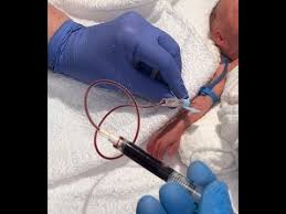 Image result for Venous Blood Sampling