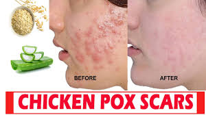 Petua hilang demam campak dewasa. Cara Cepat Untuk Hilangkan Parut Chicken Pox Dunia Farisya