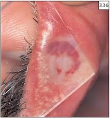 Image result for Diascopy