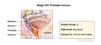 Cancer which has spread to the lymph nodes can sometimes be detected if the lymph nodes have become enlarged. Prostate Cancer Hematology Oncology Associates Of Cny