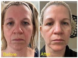 Can someone please tell me which one out of the vitacid creams you use  first , the less concentrated ,I have bought all 3 different strengths