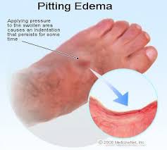 Depending on the size and the location of the blood clot, blood flow can be impacted to varying degrees. Edema Definition Causes Treatments Pictures Symptoms