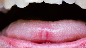 Image result for yellow tongue infection