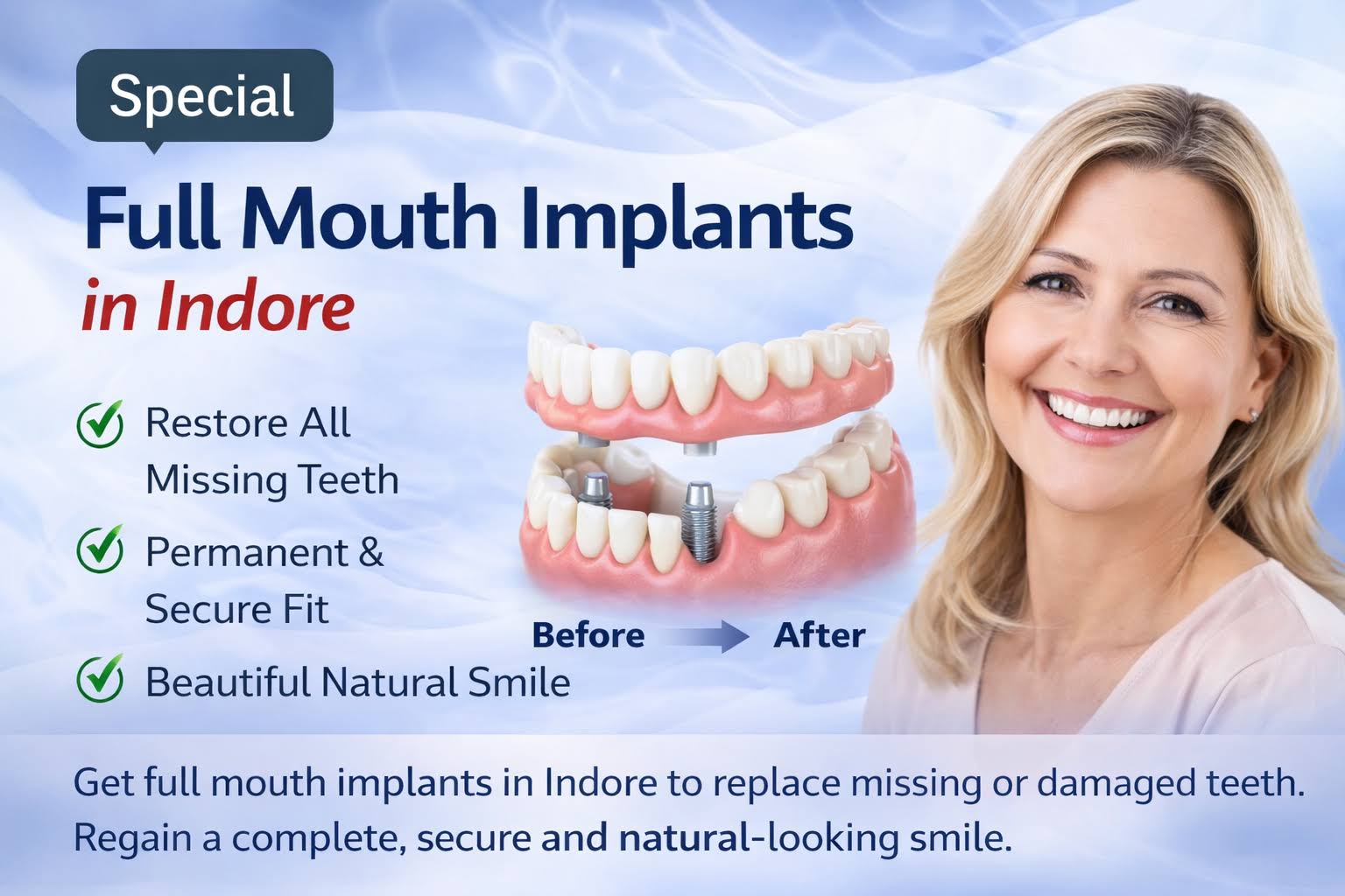 Full Mouth Implants in Indore product image