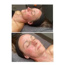 ✨ 6 Weeks. Real Results. ✨ Just 6 weeks of consistent skincare, barrier  repair, and targeted Glow Facials — and the difference speaks for itself!  💆‍♀️🌿 Powered by our signature Fab Skincare