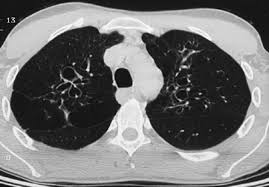 The worse your symptoms are, the more aggressive your healthcare provider will be in diagnosing and starting treatment. Pulmonary Aspergillosis A Clinical Review European Respiratory Society