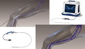 Image result for Radiofrequency Surgery