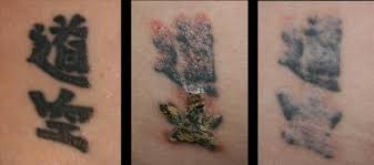 Maybe you would like to learn more about one of these? Shark Tank Tattoo Removal