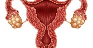Polycystic ovary syndrome (pcos) is the most common endocrine disorder in women of reproductive age that is characterized by reproductive and metabolic disorders. Pcos Und Schwangerschaft Teil 1 Ivi
