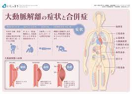 大動脈解離の症状と合併症 infographics 解離 大動脈 循環系