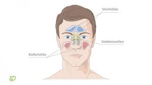 Antibiotika für sinusitis, die durch bakterien verursacht wird, sind die primären mittel der behandlung. Nasennebenhohlenentzundung Sinusitis Symptome Hausmittel Medikamente Dauer Onmeda De