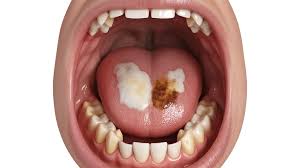 Image result for oral thrush symptoms roof of the mouth