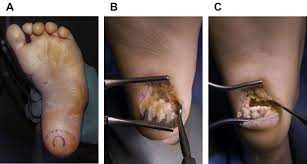 We did not find results for: Correction Of The Neglected Clubfoot In The Adolescent And Adult Patient Foot And Ankle Clinics