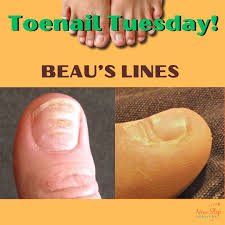 Image result for Beau lines feet