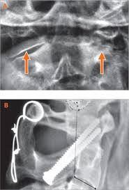 Oft reibt bei ausgeprägter arthrose knochen an knochen, sodass es zum verschleiß der knochensubstanz kommt. Operation Der Degenerativen Halswirbelsaule Schulthess Klinik
