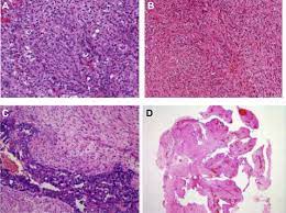 Content updated daily for popular categories Euracan Iaslc Proposals For Updating The Histologic Classification Of Pleural Mesothelioma Towards A More Multidisciplinary Approach Sciencedirect