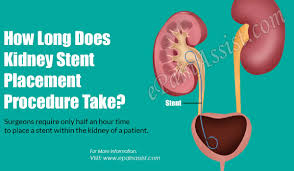 How Long Does Kidney Stent Placement Procedure Take
