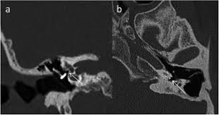 Image result for Myringosclerosis