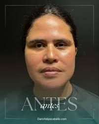 ✨ Desde Nueva York hasta Barranquilla, ella confió en el Dr. Cabello para  recuperar su expresión natural. El Hybrid Facelift combina lo mejor de la  técnica quirúrgica profunda con tecnología moderna, logrando