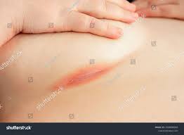 Image result for Intertrigo under breasts