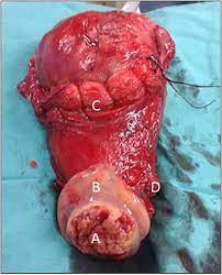 Locally Advanced Cervical Cancer Complicating Pregnancy A Case Of Competing Risks From The Catholic University Of The Sacred Heart In Rome Sciencedirect